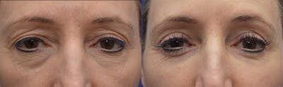 Blepharoplasty Before & After Gallery - Patient 345736 - Image 1