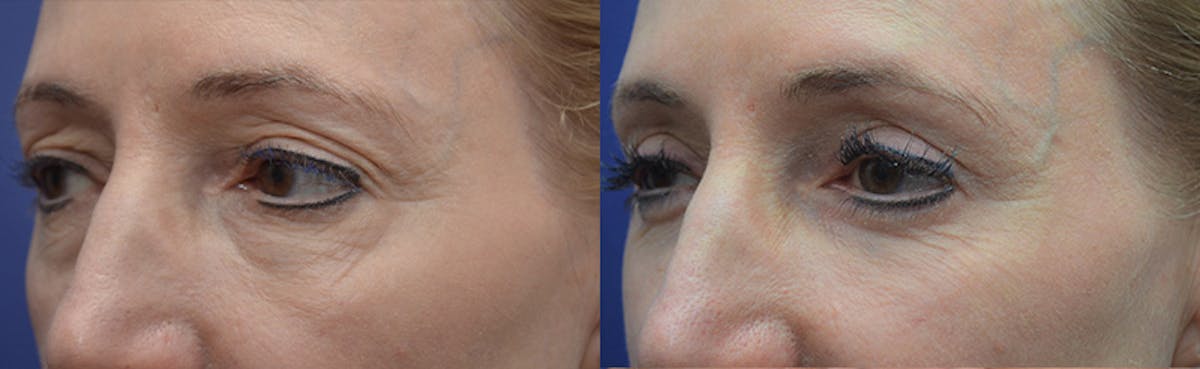 Eyelid Surgery Before & After Gallery - Patient 419869 - Image 2