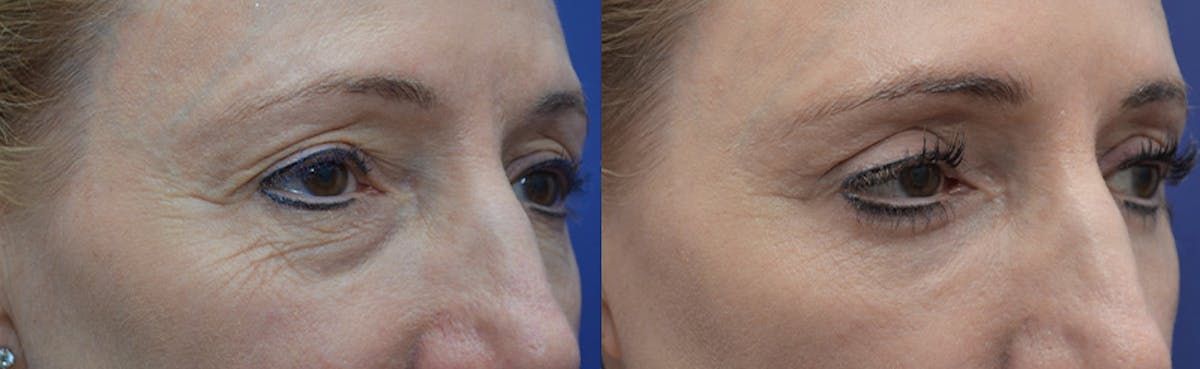 Eyelid Surgery Before & After Gallery - Patient 419869 - Image 3