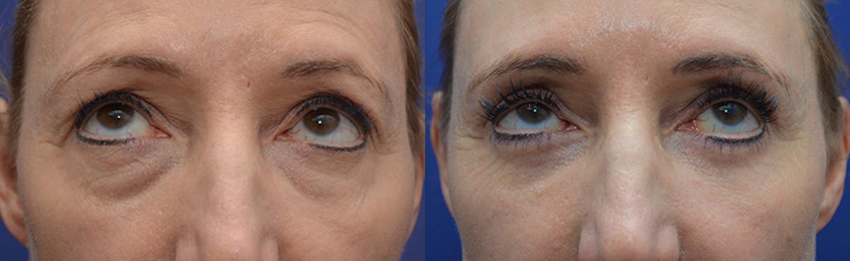 Eyelid Surgery Before & After Gallery - Patient 419869 - Image 4