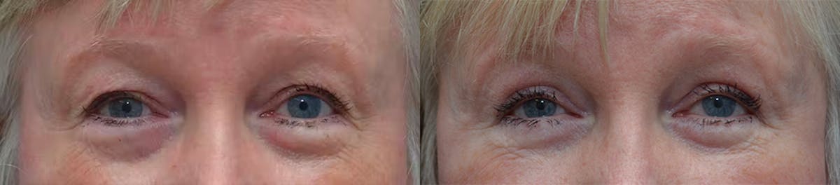 Eyelid Surgery Before & After Gallery - Patient 122312 - Image 1