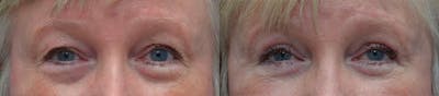 Blepharoplasty Before & After Gallery - Patient 259659 - Image 1