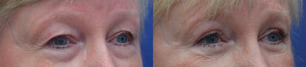 Eyelid Surgery Before & After Gallery - Patient 122312 - Image 2