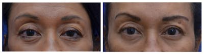 Upper Eyelid Ptosis Repair Before & After Gallery - Patient 463029 - Image 1