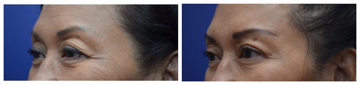 Blepharoplasty Before & After Gallery - Patient 262928 - Image 2