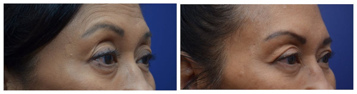 Blepharoplasty Before & After Gallery - Patient 262928 - Image 3