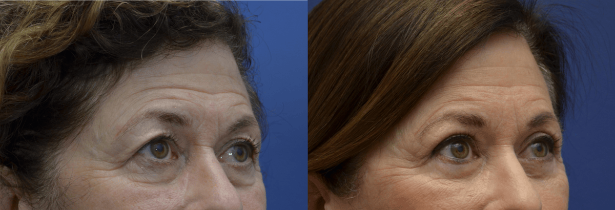 Eyelid Surgery Before & After Gallery - Patient 162771 - Image 1