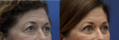 Blepharoplasty Before & After Gallery - Patient 343760 - Image 1