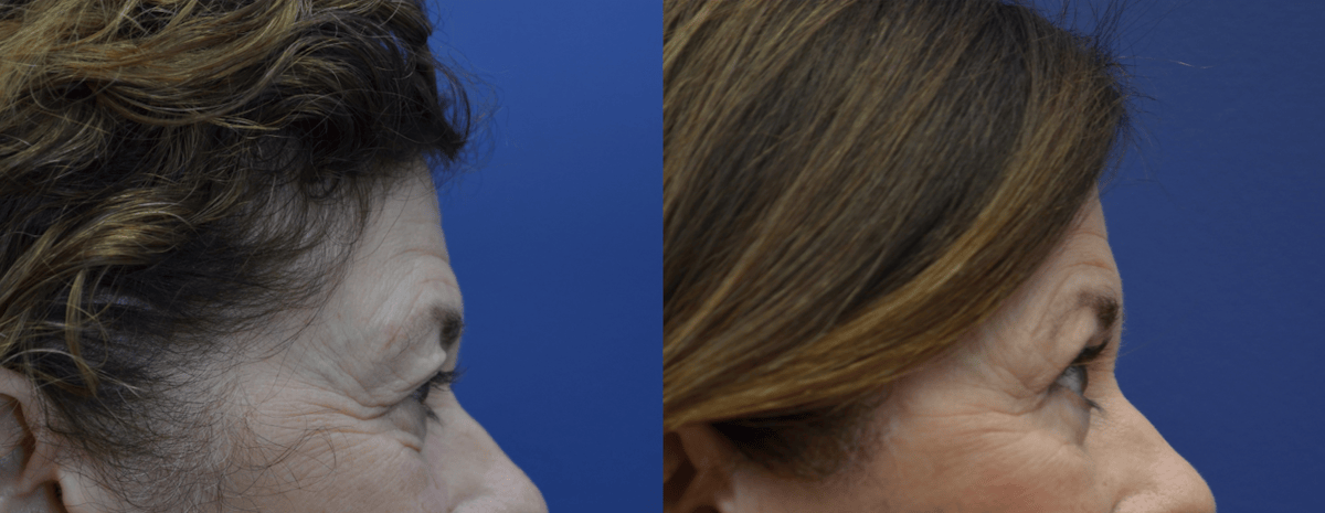Eyelid Surgery Before & After Gallery - Patient 162771 - Image 2