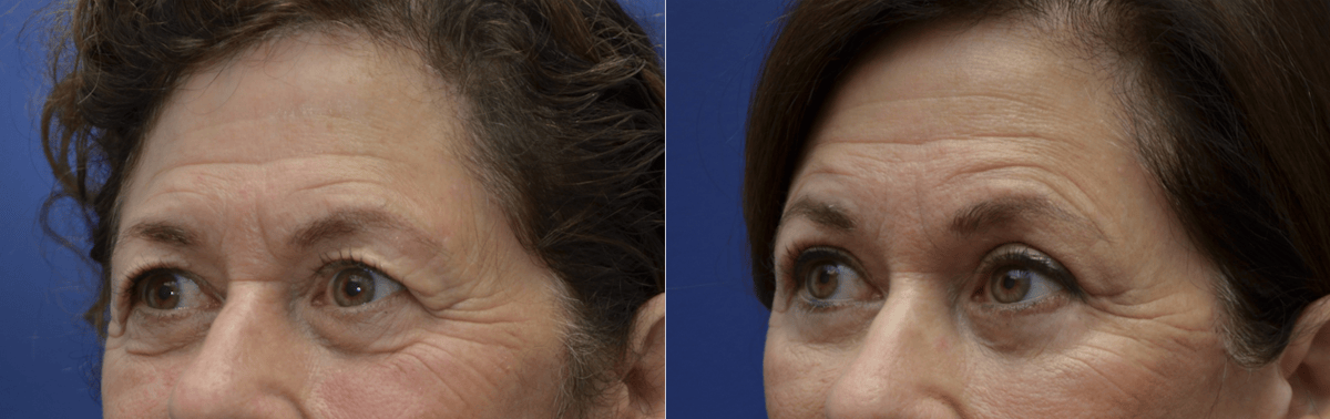 Eyelid Surgery Before & After Gallery - Patient 162771 - Image 3