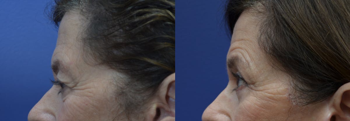 Eyelid Surgery Before & After Gallery - Patient 162771 - Image 4