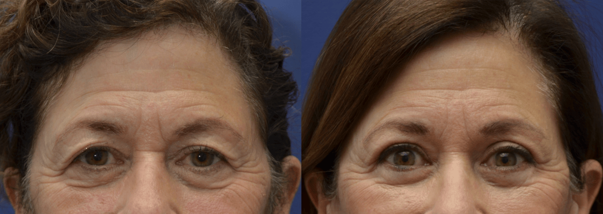 Eyelid Surgery Before & After Gallery - Patient 162771 - Image 5