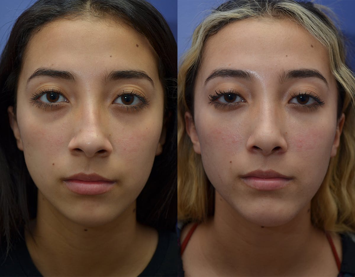 Under Eye Rejuvenation Before & After Gallery - Patient 426906 - Image 1