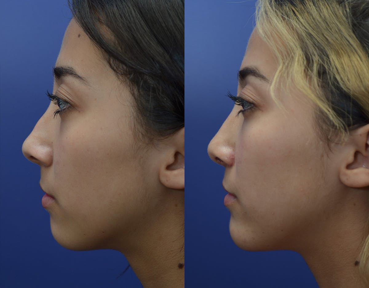 Under Eye Rejuvenation Before & After Gallery - Patient 426906 - Image 3