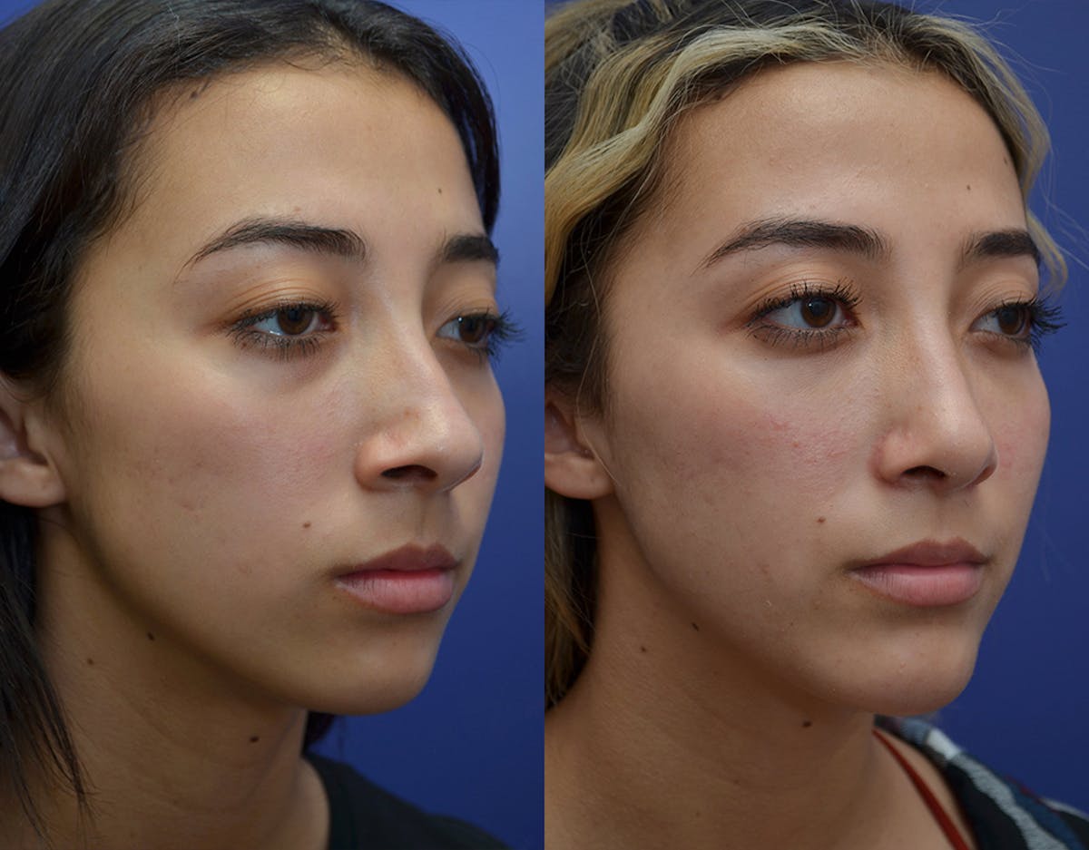Under Eye Rejuvenation Before & After Gallery - Patient 426906 - Image 4
