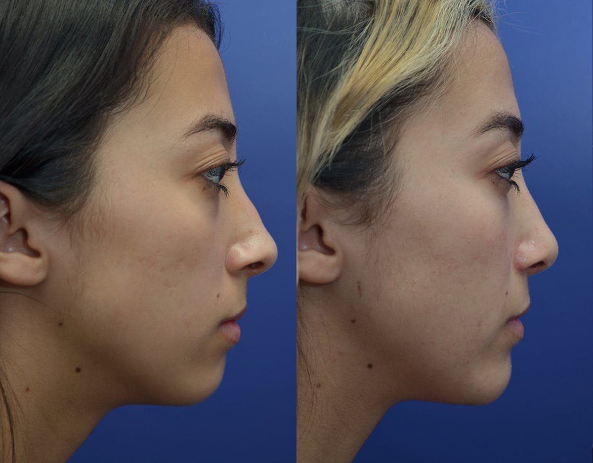 Under Eye Rejuvenation Before & After Gallery - Patient 426906 - Image 5