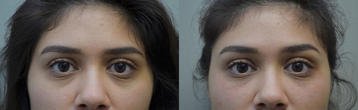 Under Eye Rejuvenation Before & After Gallery - Patient 178477 - Image 1
