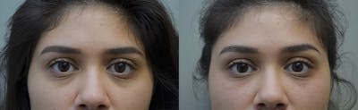 Under Eye Rejuvenation Before & After Gallery - Patient 178477 - Image 1