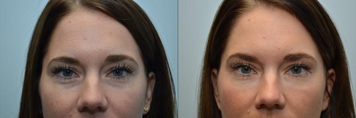 Under Eye Rejuvenation Before & After Gallery - Patient 264712 - Image 1