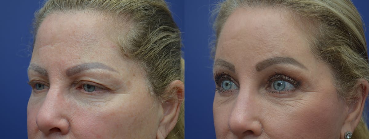 Brow Lift (Forehead Lift) Before & After Gallery - Patient 169243 - Image 2