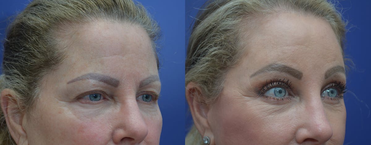 Brow Lift (Forehead Lift) Before & After Gallery - Patient 169243 - Image 4