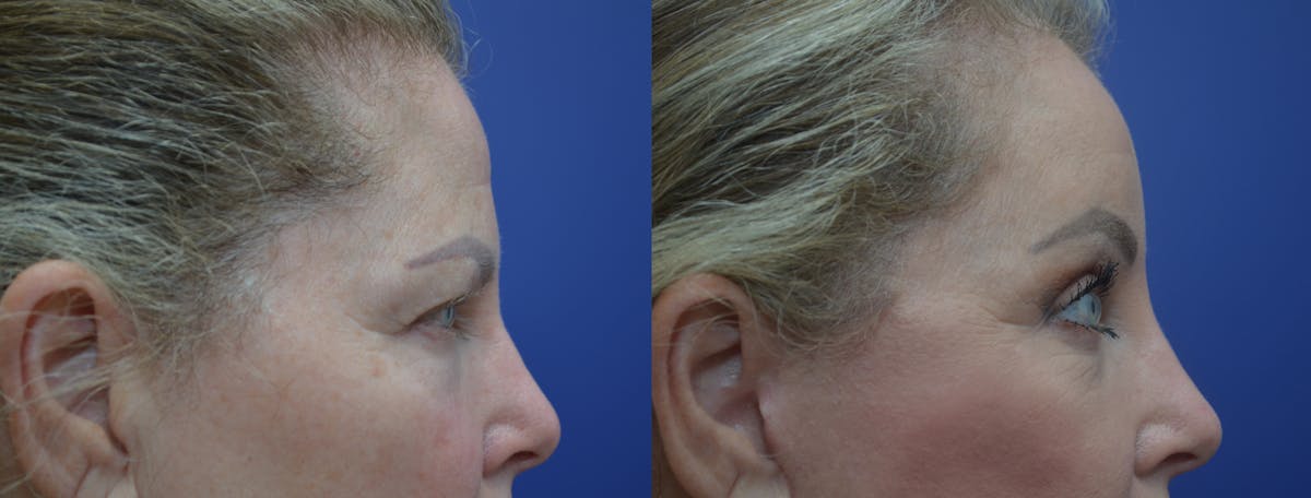 Brow Lift (Forehead Lift) Before & After Gallery - Patient 169243 - Image 5
