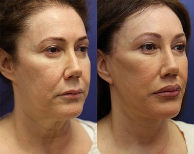 Brow Lift (Forehead Lift) Before & After Gallery - Patient 384820 - Image 1