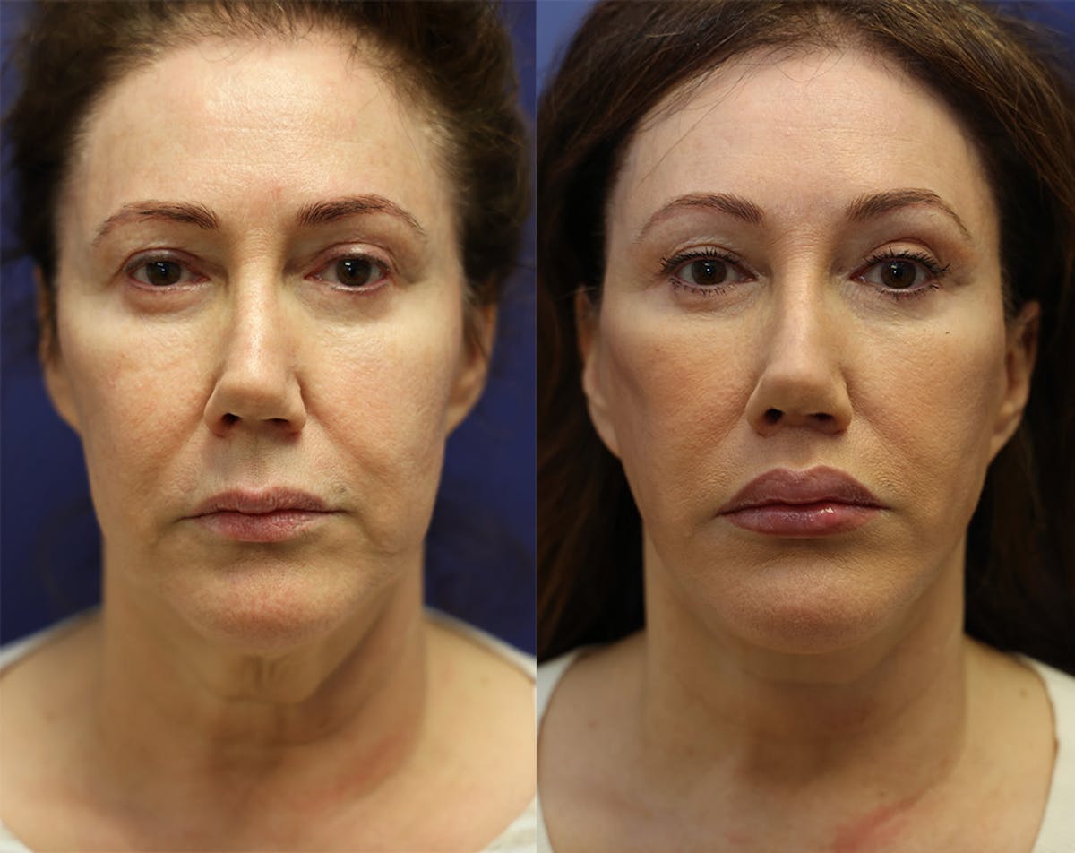 Lip Augmentation Before & After Gallery - Patient 401267 - Image 1