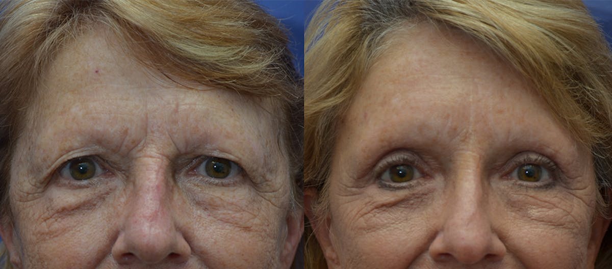 Brow Lift (Forehead Lift) Before & After Gallery - Patient 424104 - Image 1