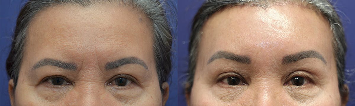 Brow Lift (Forehead Lift) Before & After Gallery - Patient 385357 - Image 1