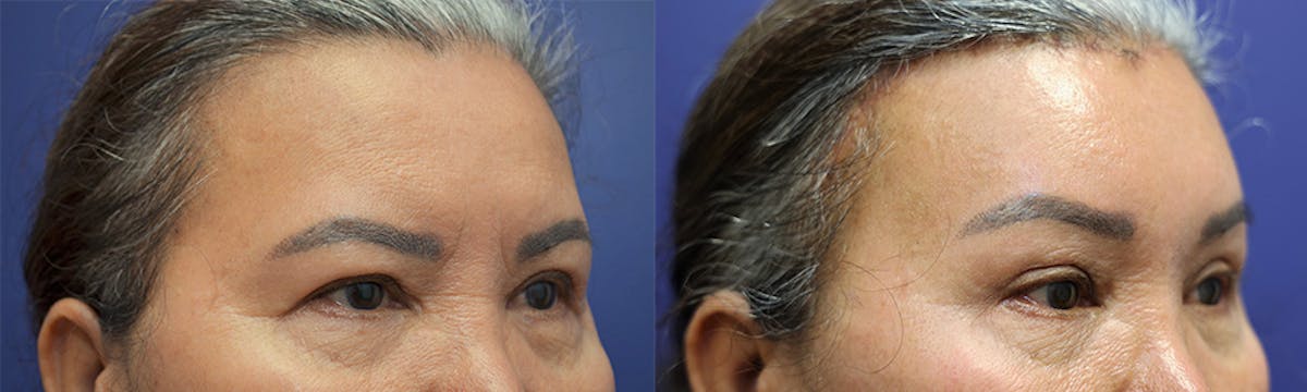 Brow Lift (Forehead Lift) Before & After Gallery - Patient 385357 - Image 2
