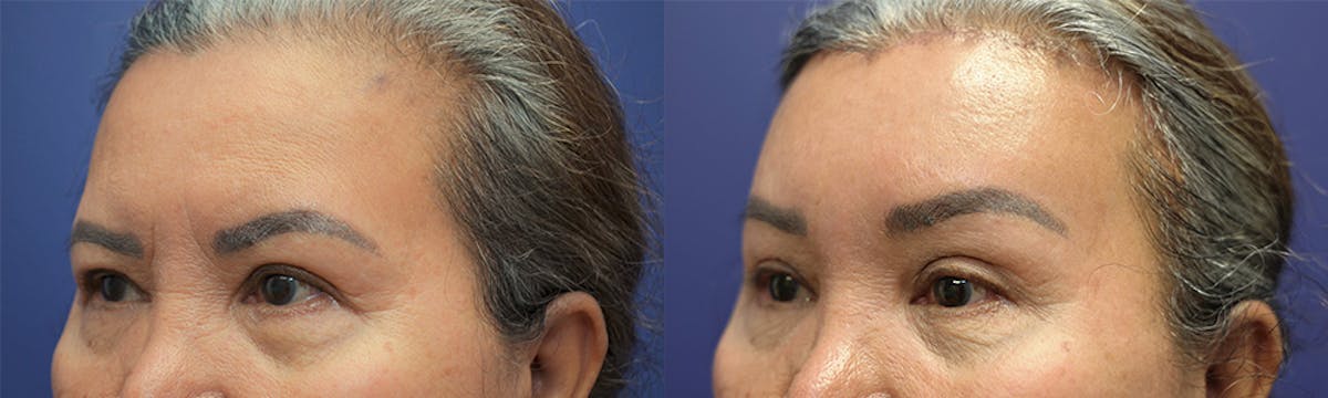Brow Lift (Forehead Lift) Before & After Gallery - Patient 385357 - Image 3