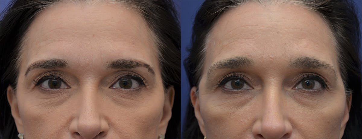 Brow Lift (Forehead Lift) Before & After Gallery - Patient 218436 - Image 1