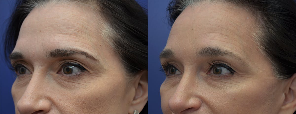Brow Lift (Forehead Lift) Before & After Gallery - Patient 218436 - Image 2