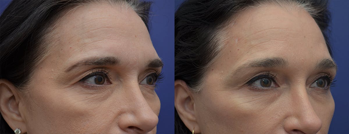 Brow Lift (Forehead Lift) Before & After Gallery - Patient 218436 - Image 3
