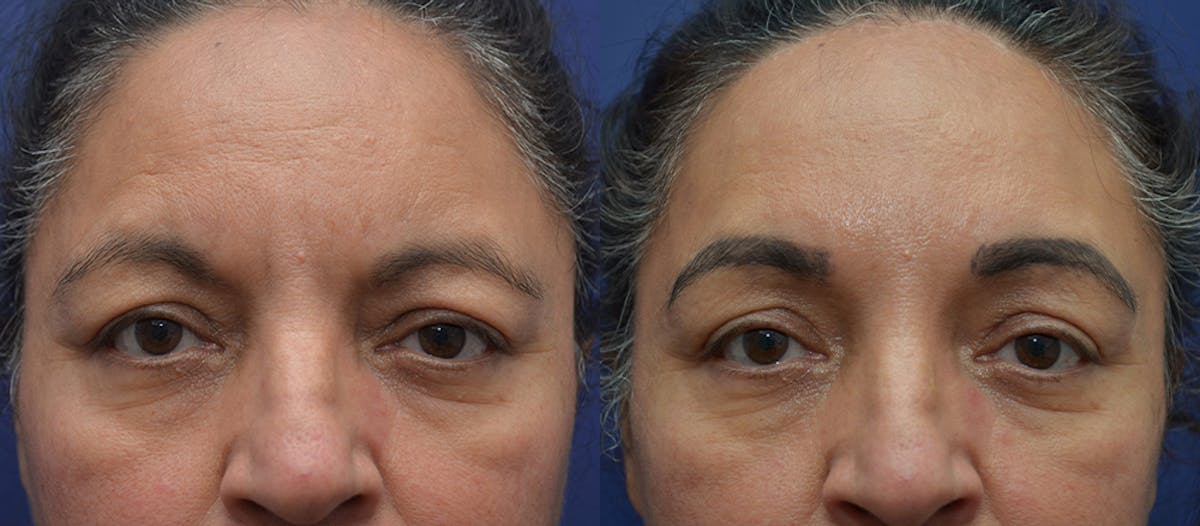 Brow Lift (Forehead Lift) Before & After Gallery - Patient 212851 - Image 1