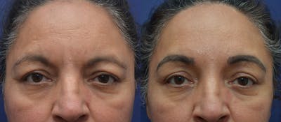 Brow Lift (Forehead Lift) Before & After Gallery - Patient 212851 - Image 1