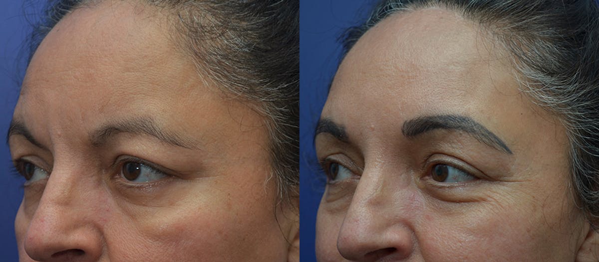 Brow Lift (Forehead Lift) Before & After Gallery - Patient 212851 - Image 2