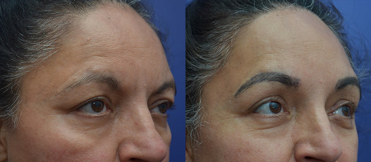 Brow Lift (Forehead Lift) Before & After Gallery - Patient 212851 - Image 3