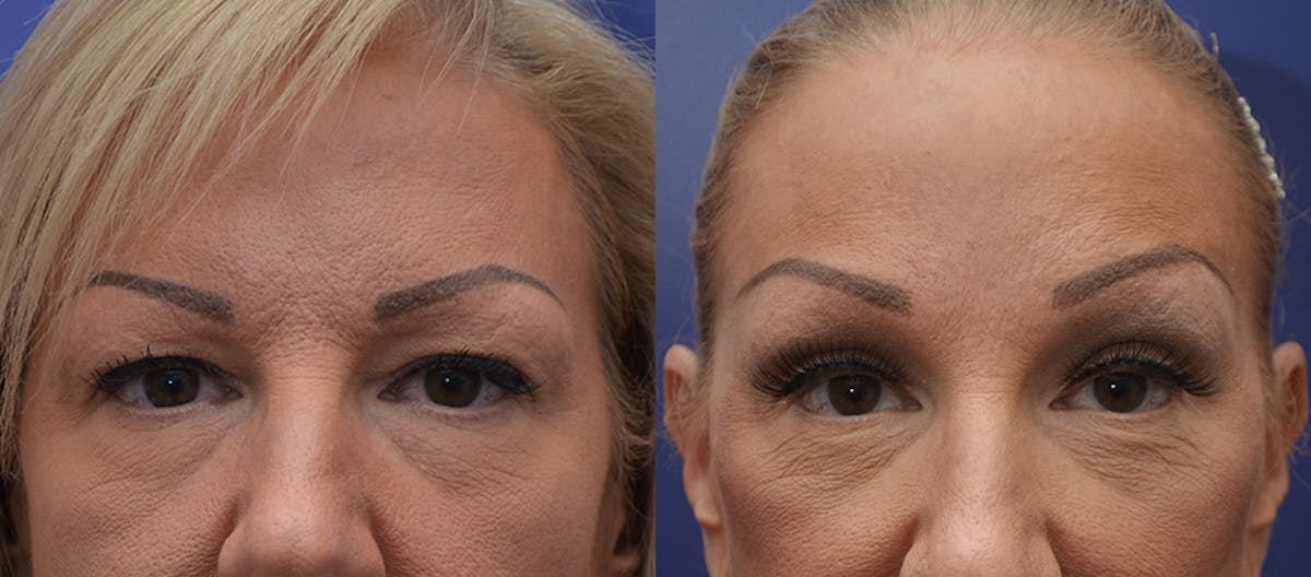 Brow Lift (Forehead Lift) Before & After Gallery - Patient 133074 - Image 1
