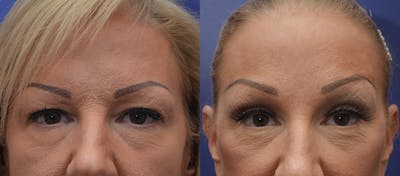 Brow Lift (Forehead Lift) Before & After Gallery - Patient 133074 - Image 1