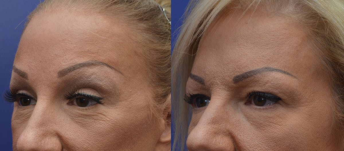 Brow Lift (Forehead Lift) Before & After Gallery - Patient 133074 - Image 2