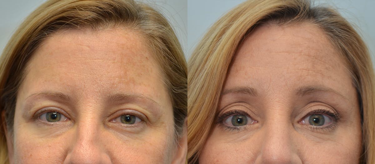 Brow Lift (Forehead Lift) Before & After Gallery - Patient 399994 - Image 1