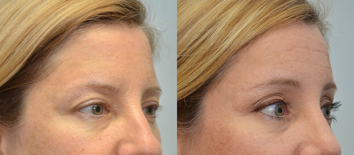 Brow Lift (Forehead Lift) Before & After Gallery - Patient 399994 - Image 3