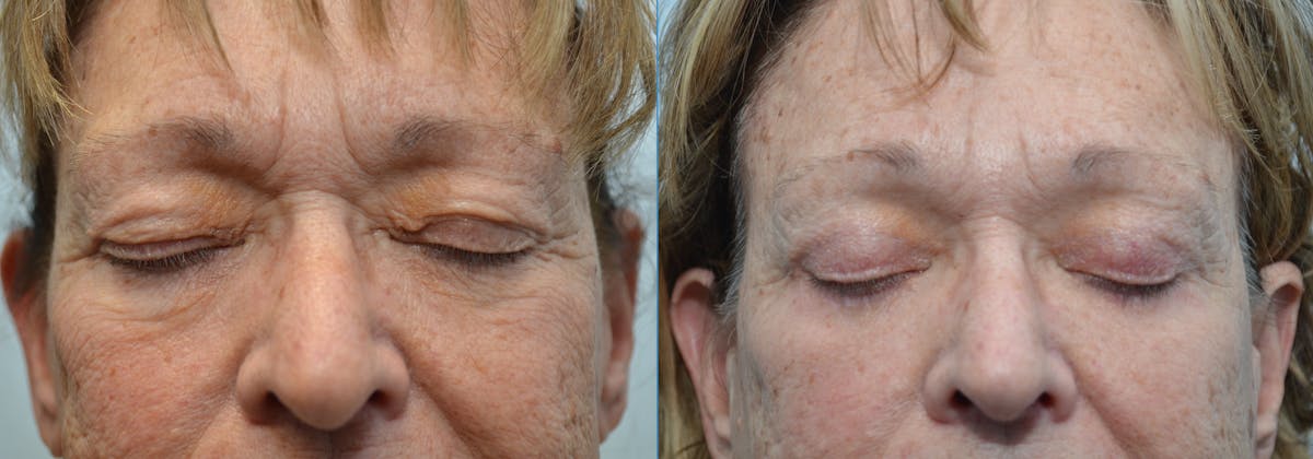 Brow Lift (Forehead Lift) Before & After Gallery - Patient 393462 - Image 2