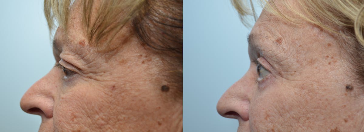 Brow Lift (Forehead Lift) Before & After Gallery - Patient 393462 - Image 3