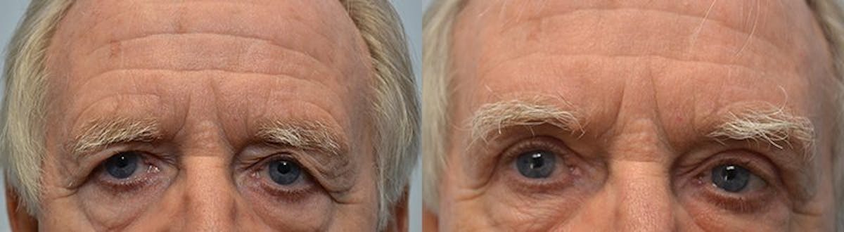 Brow Lift (Forehead Lift) Before & After Gallery - Patient 792943 - Image 1