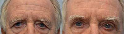 Brow Lift (Forehead Lift) Before & After Gallery - Patient 792943 - Image 1