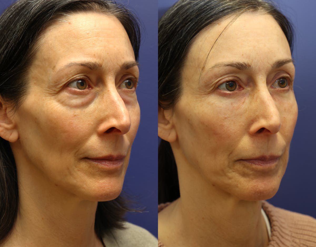 Facial Revolumizing (Fat Transfer) Before & After Gallery - Patient 250565 - Image 2