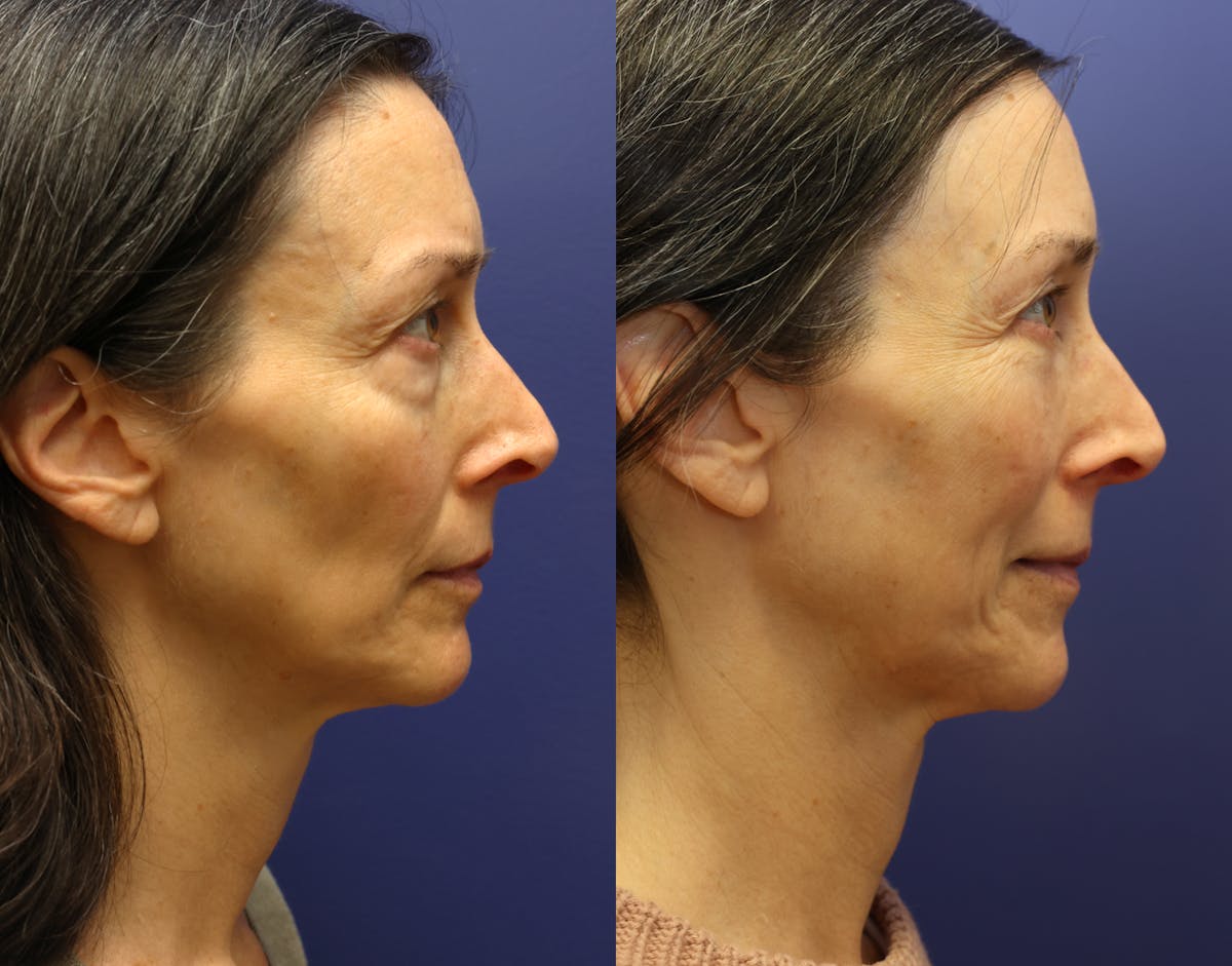 Facial Revolumizing (Fat Transfer) Before & After Gallery - Patient 250565 - Image 3